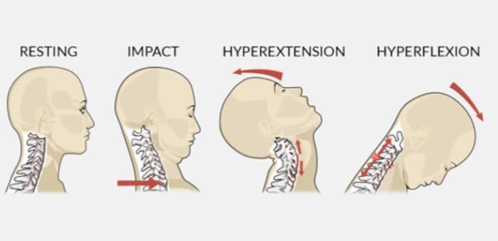 Myths & Misconceptions of Whiplash